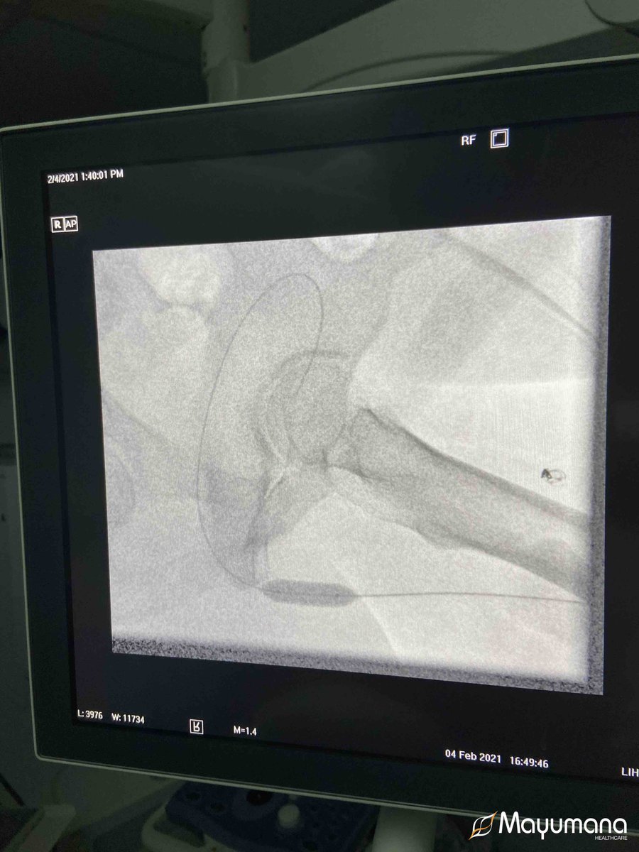Mayumana's tweet photo. Met trots kan @Mayumana delen dat, in exclusieve samenwerking met @urotronic en @LABORIEMEDICAL, de eerste 2 #Optilume® procedures succesvol zijn uitgevoerd in NL. Afgelopen donderdag had drs. Taubert de eer om met dit innovatieve product aan de slag te gaan!

#urethralstricture https://t.co/uAux5nLYYZ