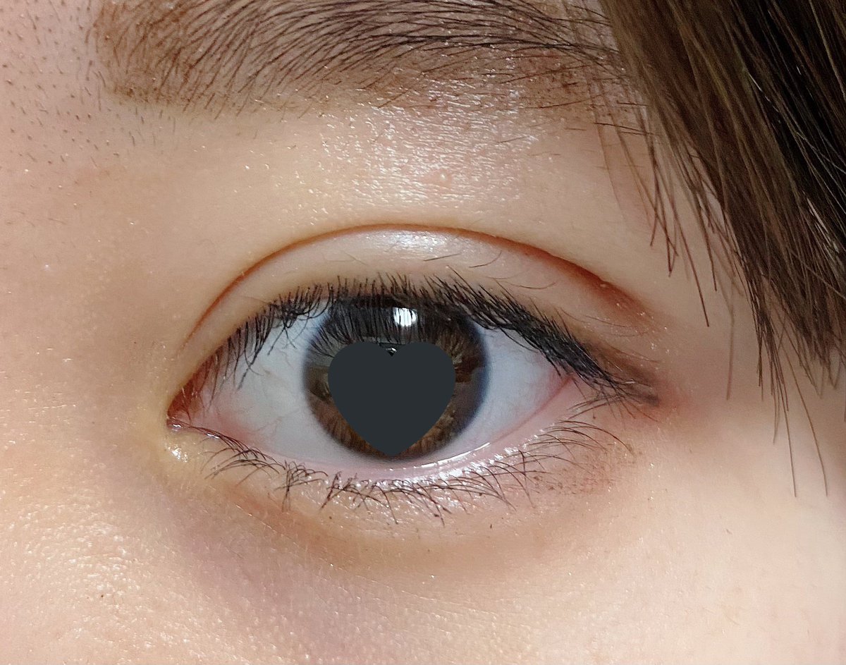 くう 埋没 Dt10日目 夕方に撮ったからメイク崩れまくってます そしてアイシャドウ傷口にめちゃくちゃたまる フォーエバー二重術 湘南美容外科 埋没経過 埋没 二重整形