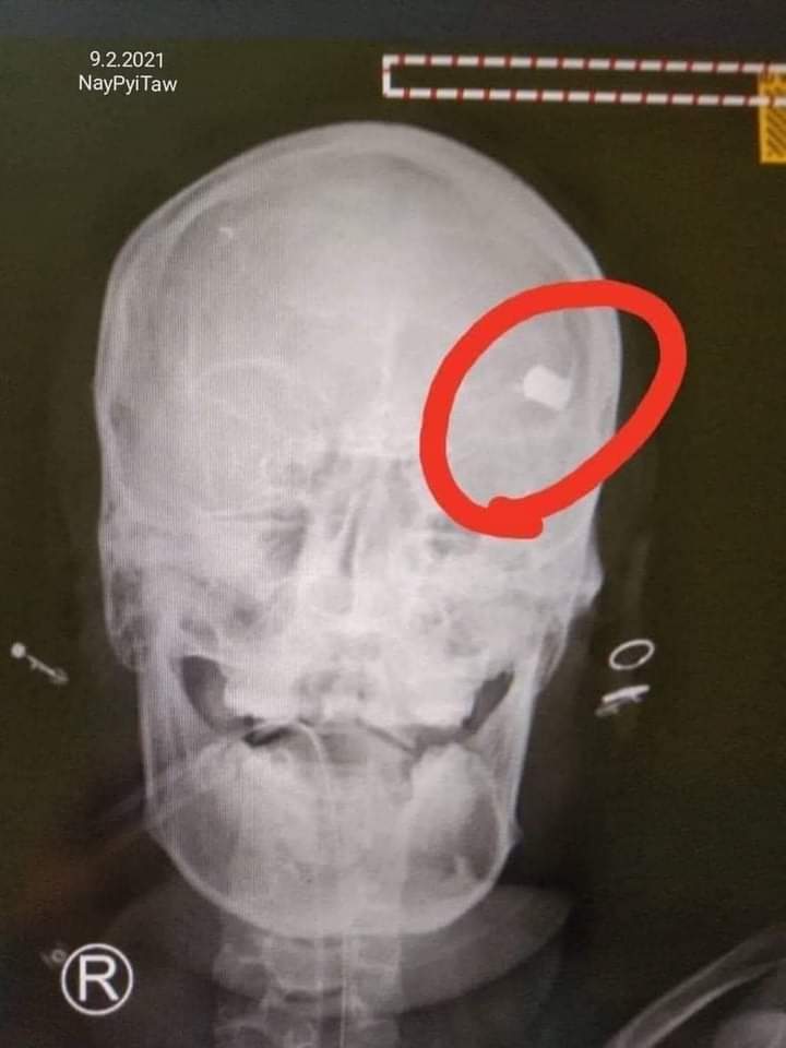 The gun that shotted to protester(Mya Thet Thet Khine) by burmese police in #NayPyiDaw is BA-93 SMG(Submachine Gun)  

HEAR OUR VOICE 

#WhatsHappeningInMyanmar 
#Feb9Coup