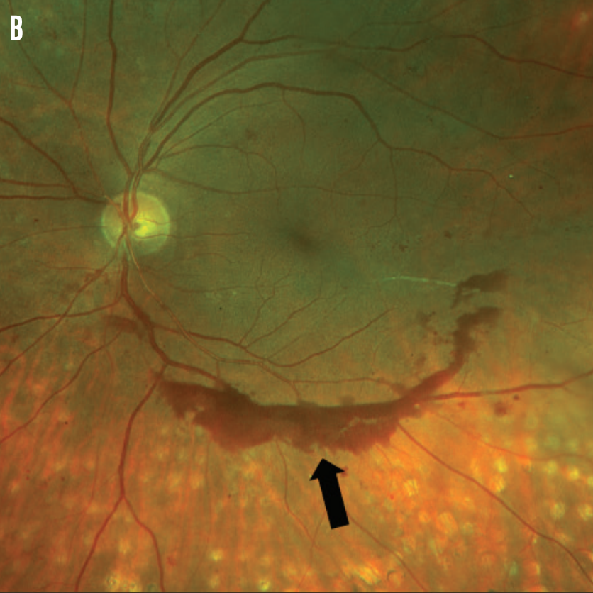 ModOptometry's tweet image. Do you know the usual suspects for retinal lesions? Dr. Jessica Haynes outlines common suspects here: hubs.ly/H0G1tg-0

#ModernOptometry #Optometry #Optometrist #EyeCare #EyeHealth #EyeCareTips #EyeHealthTips