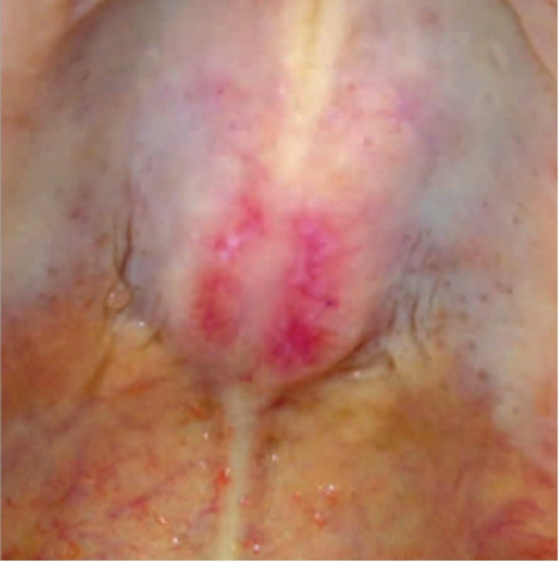 CASE 2:Suppose instead you have a patient with:Psoriatic-like lesionsHyperkeratotic papules on palmar & digital flexor surfacesThis lesion  on the roof of the mouth