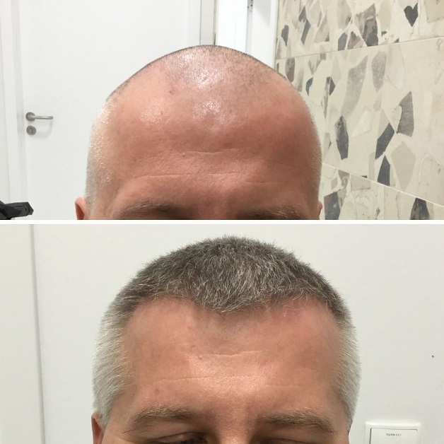 Hair Transplant Turkey - Best Hair Transplant Turkey Award 2021