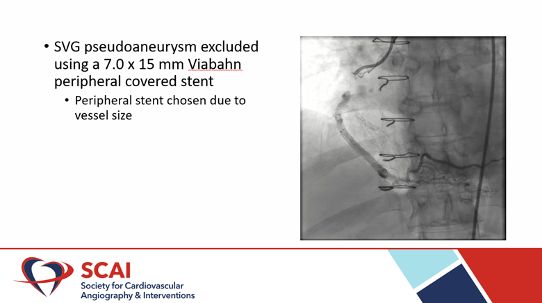 SCAI (@scai) on Twitter photo Thanks for voting! Here's how the case happened
<a href="/fischman_david/">David L. Fischman</a> <a href="/DocSavageTJU/">Michael Savage</a> @jadomranIC @pooh_velagapudi <a href="/DrDrewKleinPHI/">Drew Klein</a> <a href="/heartdocandcrew/">Michele Voeltz</a>
<a href="/taraloujones/">Tara Jones, MD/PharmD</a> <a href="/sahilparikhmd/">Sahil A. Parikh, MD</a> Thanks for voting! Here's how the case happened
<a href="/fischman_david/">David L. Fischman</a> <a href="/DocSavageTJU/">Michael Savage</a> @jadomranIC @pooh_velagapudi <a href="/DrDrewKleinPHI/">Drew Klein</a> <a href="/heartdocandcrew/">Michele Voeltz</a>
<a href="/taraloujones/">Tara Jones, MD/PharmD</a> <a href="/sahilparikhmd/">Sahil A. Parikh, MD</a>