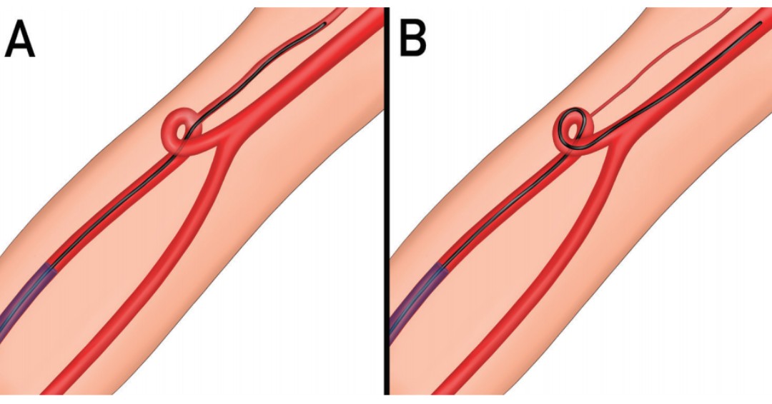 JNIS Latest Content - New Devices &amp; Technologies

Luther et al: Navigating radial artery loops in neurointerventions | Journal of NeuroInterventional Surgery. ow.ly/MhJL50Dm5CO