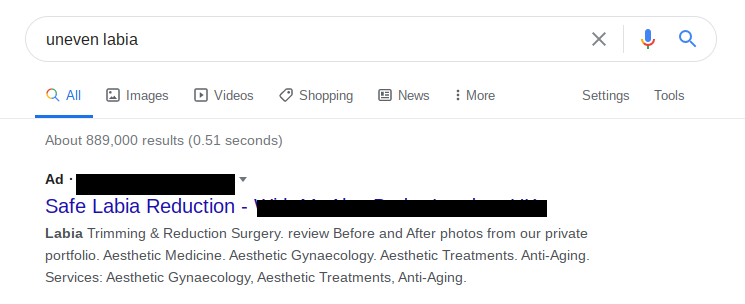The labiaplasty ads keep popping up on searches about asymmetric labia, which, again, we need to say, is normal.