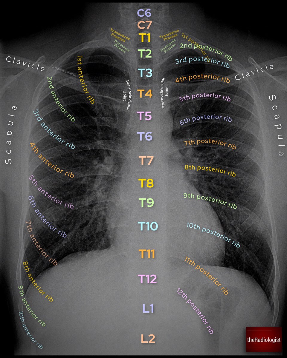 Chest X-Ray Anatomy