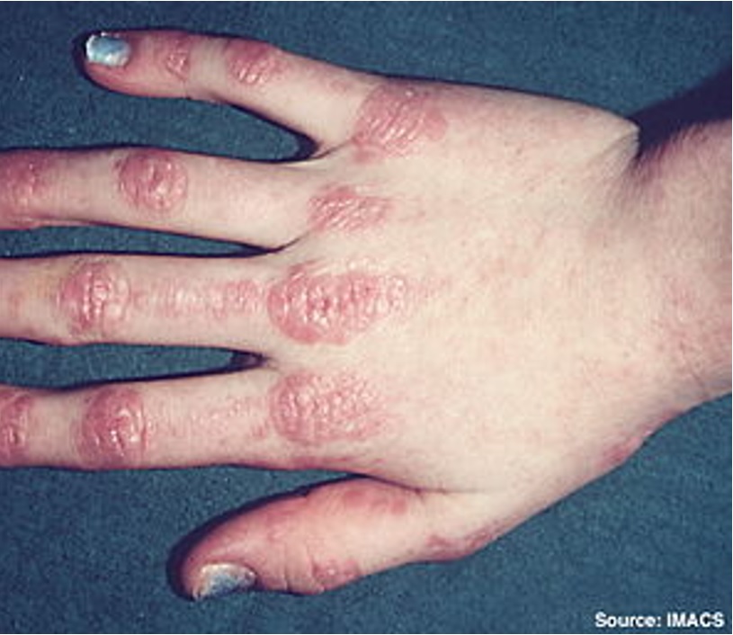 Inflammatory myopathies:Aka idiopathic inflammatory myopathies (IIM); can present with a variety of symptoms & most commonly *symmetric proximal muscle weakness*Other signs include: heliotrope rash , Gottron’s papules (see image), interstitial lung disease, dysphagia