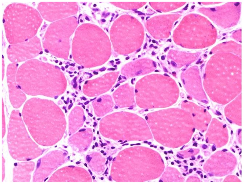 IIM mechanism?Lymphocytic infiltrates in muscle tissue and expression of autoantibodies against muscle are part of the immune mechanisms contributing to myositis!T- and B-cell proliferation and activation can be seen on muscle biopsy