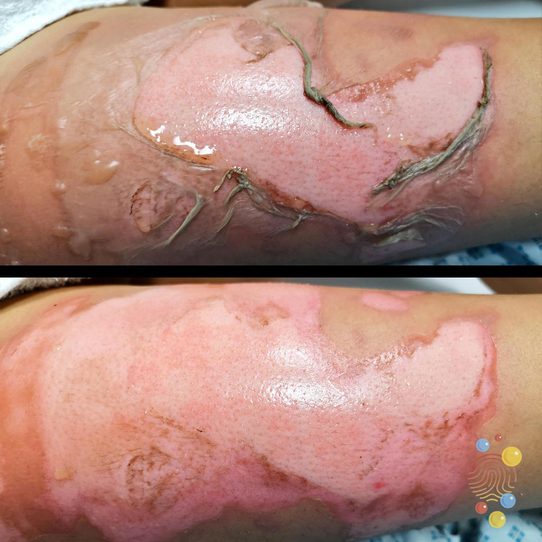 Deroofing (not every centre does the same here). We deroof all of ours. Sometimes the burn looks much larger after deroofing + you can clean it, get a better view + assessment. Dress with a non-adherent dressing then gauze to soak up the exudate.Review in 2-3 days.8/12