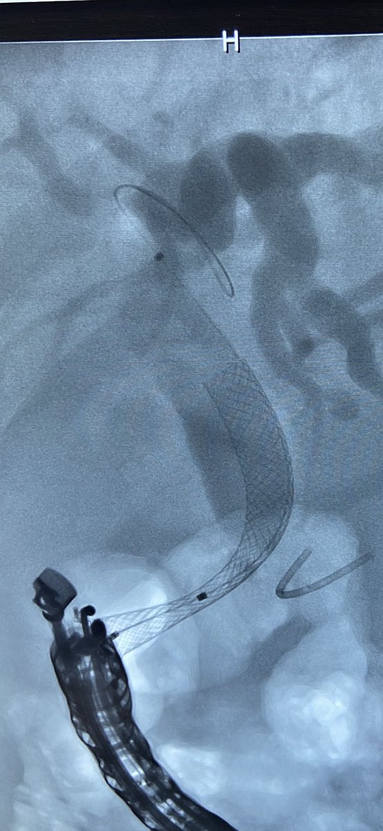 GauravMuktesh's tweet photo. EUS guided CDS as a rescue to failed ercp for palliative biliary stenting in a 62 year old patient with metastatic periampullary ca. Procedure duration 8 min vs 25 min for ercp and two inadvertent pancreatic guidewire insertions.
#GITwitter 
#earlyrescue #eusbd #eus #backup https://t.co/6JuDvnfgBK