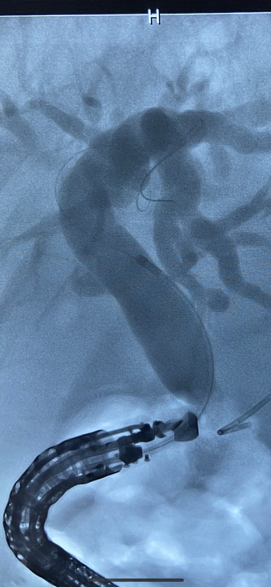 GauravMuktesh's tweet photo. EUS guided CDS as a rescue to failed ercp for palliative biliary stenting in a 62 year old patient with metastatic periampullary ca. Procedure duration 8 min vs 25 min for ercp and two inadvertent pancreatic guidewire insertions.
#GITwitter 
#earlyrescue #eusbd #eus #backup https://t.co/6JuDvnfgBK
