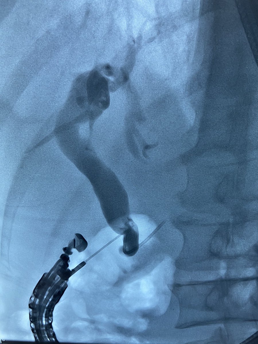 GauravMuktesh's tweet photo. EUS guided CDS as a rescue to failed ercp for palliative biliary stenting in a 62 year old patient with metastatic periampullary ca. Procedure duration 8 min vs 25 min for ercp and two inadvertent pancreatic guidewire insertions.
#GITwitter 
#earlyrescue #eusbd #eus #backup https://t.co/6JuDvnfgBK