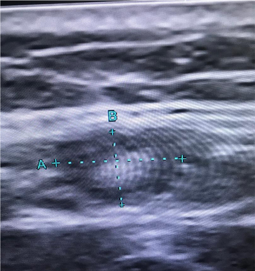 Part 3. Man in his sixties with history of papillary thyroid carcinoma (thyroidectomy). A submental 6 mm node is seen by the endocrinologist. US features are benign (oval with fat in the hilar region). Material for thyroglobulin biochemical analysis is also obtained