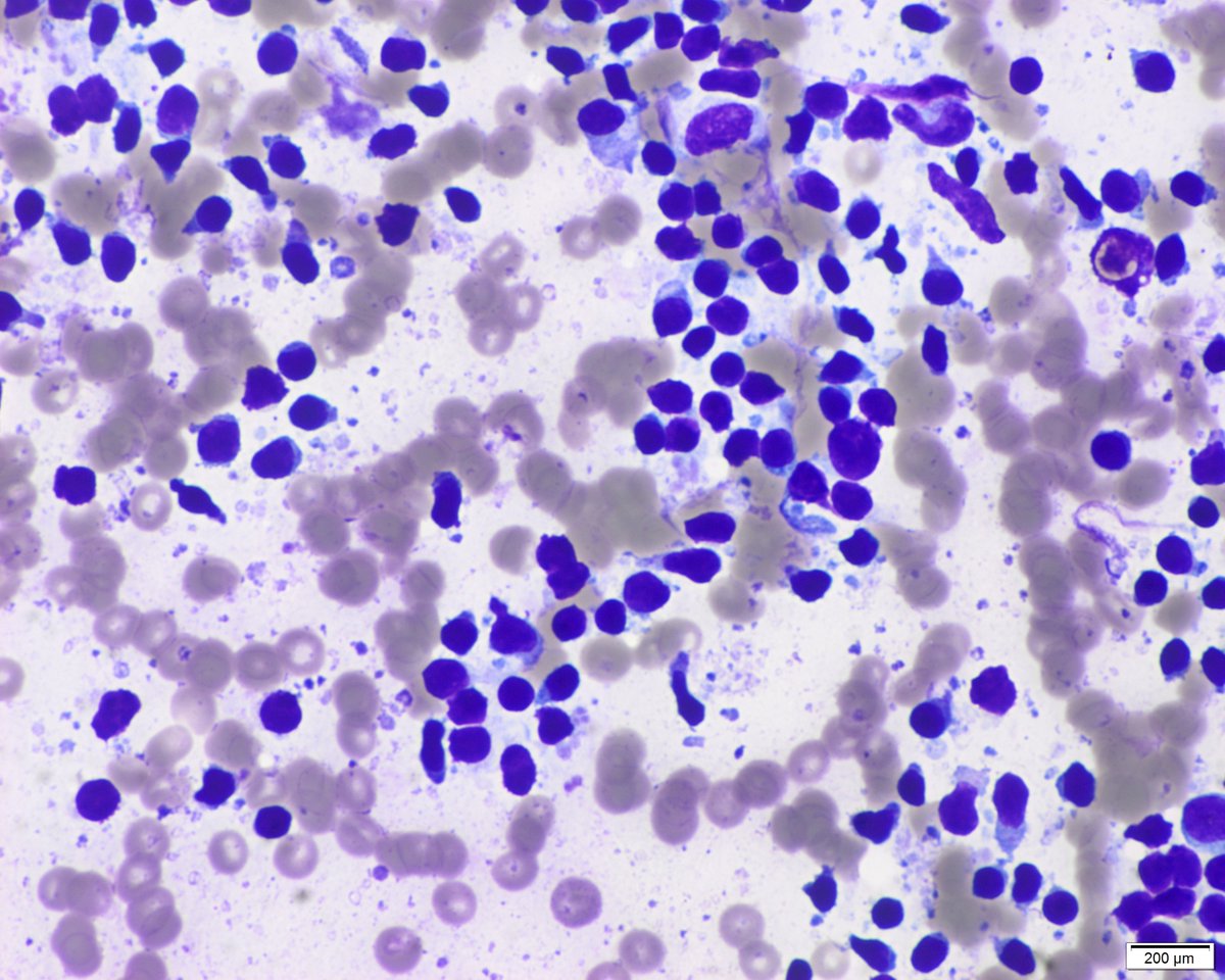 Part 3. Man in his sixties with history of papillary thyroid carcinoma (thyroidectomy). A submental 6 mm node is seen by the endocrinologist. US features are benign (oval with fat in the hilar region). Material for thyroglobulin biochemical analysis is also obtained