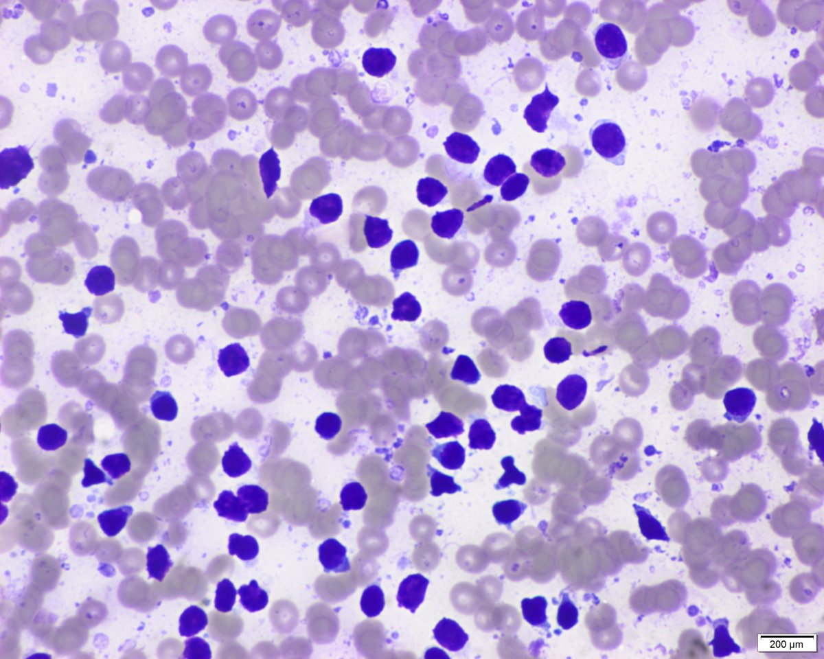 Part 3. Man in his sixties with history of papillary thyroid carcinoma (thyroidectomy). A submental 6 mm node is seen by the endocrinologist. US features are benign (oval with fat in the hilar region). Material for thyroglobulin biochemical analysis is also obtained