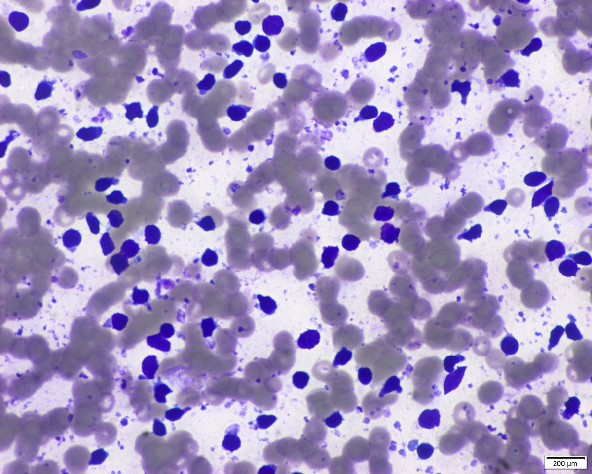 Part 3. Man in his sixties with history of papillary thyroid carcinoma (thyroidectomy). A submental 6 mm node is seen by the endocrinologist. US features are benign (oval with fat in the hilar region). Material for thyroglobulin biochemical analysis is also obtained