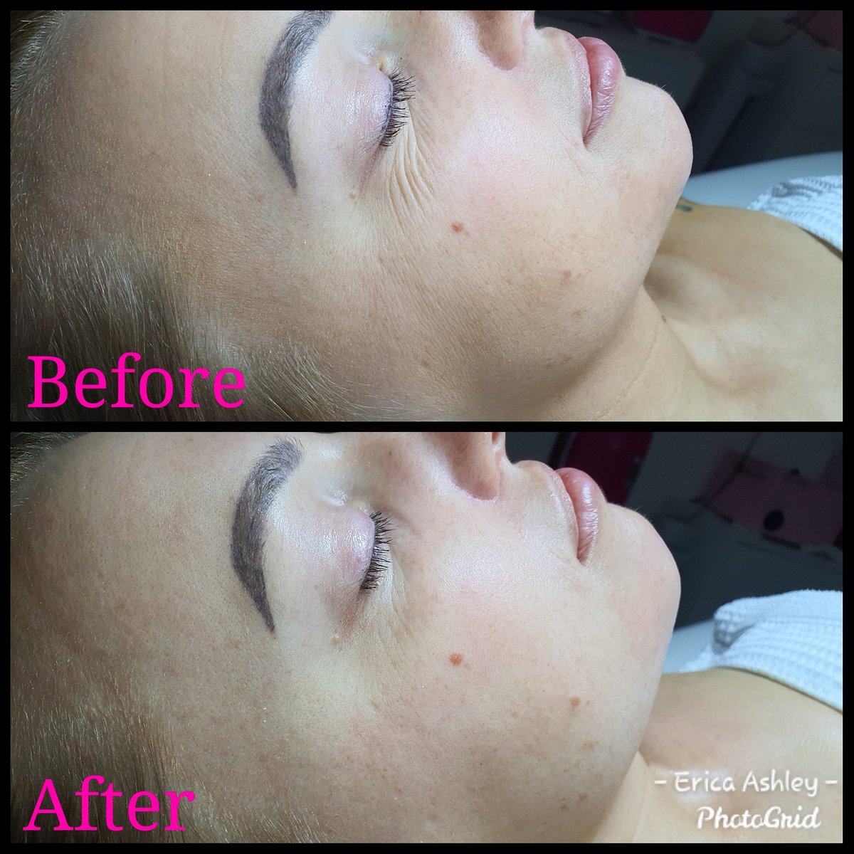 EriCareSkin's tweet photo. B&amp;A of my microdermabrasion facial!!! 😱🤩
➡️ No down time
➡️ Able to wear makeup same day or next day #Esthetician #EstheticsByEricaAshley #EstheticsByErica  #LicensedEsthetician #MicrodermabrasionFacial #Microdermabrasion #SanAntonioEsthetician #SanAntonioSpa #SanAntonioSalon https://t.co/zoGeffn2ya