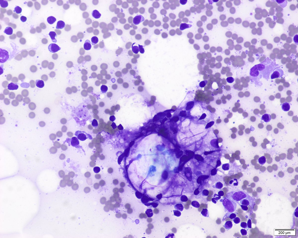 Part 5. You can even see adipocytes from the hilar region of the node (particularly in inguinal ones) and sebocyte cutaneous contamination should not mislead you. If you see this monomoprhism in a 4 cm node: biopsy. But that is the exception. Rutine is what we have shown. Thanks