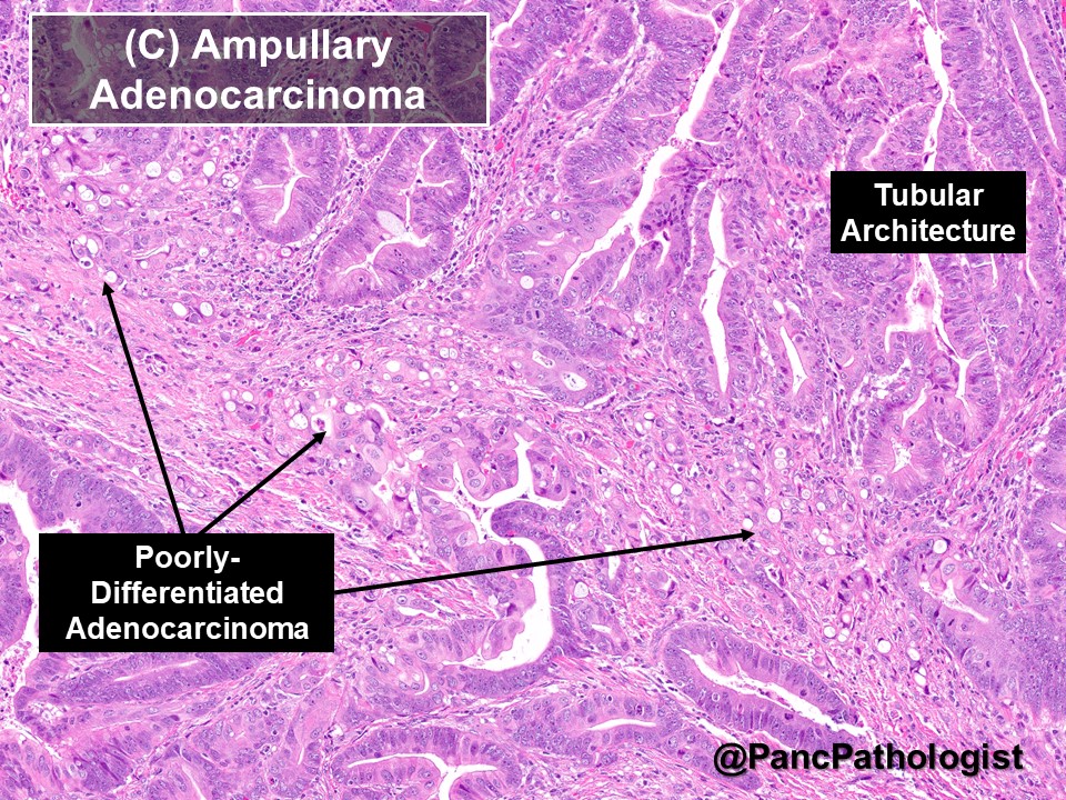 PancPathologist's tweet photo. Ampullary adenocarcinoma arising from an Intra-Ampullary Papillary-Tubular Neoplasm (IAPN) with High-Grade Dysplasia. Genetically IAPNs are distinct from IPMNs (Pancreas) and ICPNs (Gallbladder). #GIPath #Pathology https://t.co/6aV29lUJIC