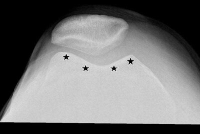 thekneedoc's tweet image. Is #trochlear #dysplasia genetic? In most cases yes; but, there may be some cases where somebody sustains a kneecap dislocation that is not put back in place when they're young &amp;amp; developmentally the trochlear groove may not form normally. medilink.us/j8ew #kneedislocation