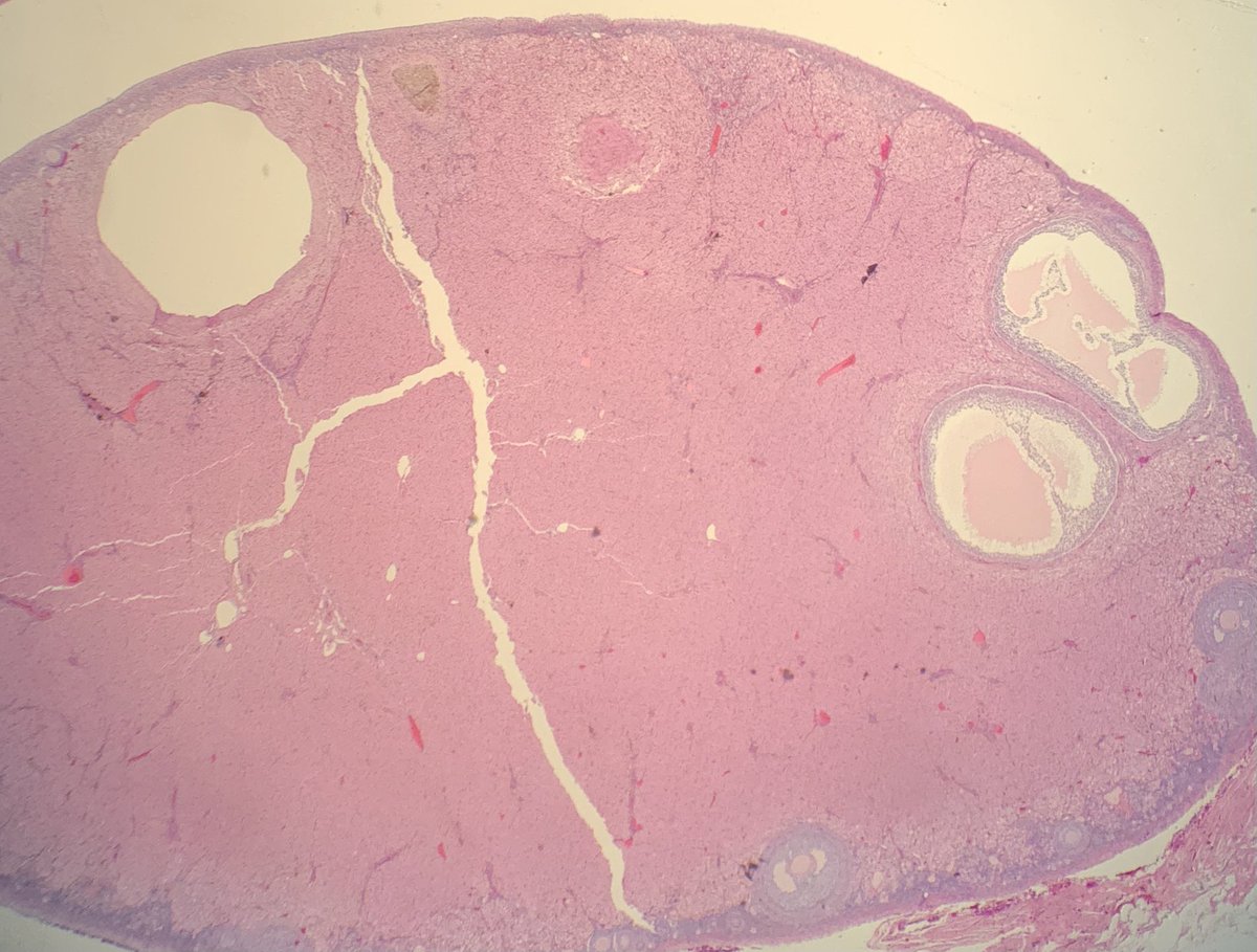 Dr Nicola Parry (@vetpathophile) on Twitter photo Great ‘classic’ #VetPath case that immediately made me think of my favourite leporid pathology expert & friend <a href="/katevetpath/">Kate Hughes</a>. Uterine mass from a rabbit w/haematuria: classic uterine ACA (exophytic & mural), w/blood clots in uterus. Even had bonus CEH & cystic ovarian follicles. Great ‘classic’ #VetPath case that immediately made me think of my favourite leporid pathology expert & friend <a href="/katevetpath/">Kate Hughes</a>. Uterine mass from a rabbit w/haematuria: classic uterine ACA (exophytic & mural), w/blood clots in uterus. Even had bonus CEH & cystic ovarian follicles.
