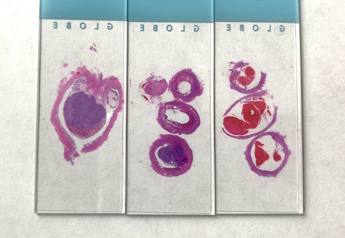 VetPathophile's tweet photo. Great ‘classic’ #VetPath case that immediately made me think of my favourite leporid pathology expert & friend @katevetpath. Uterine mass from a rabbit w/haematuria: classic uterine ACA (exophytic & mural), w/blood clots in uterus. Even had bonus CEH & cystic ovarian follicles. https://t.co/jKFcfutzwI
