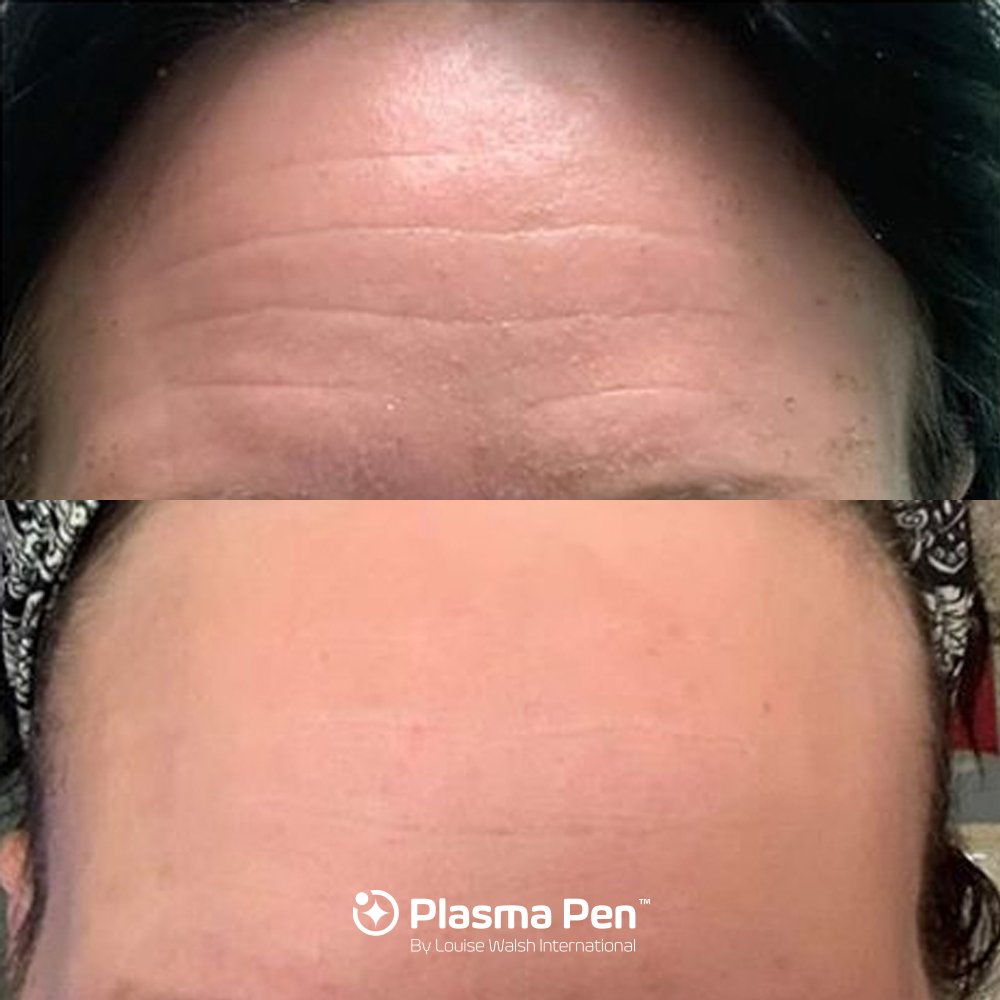 PlasmaPen by Louise Walsh International tweet media