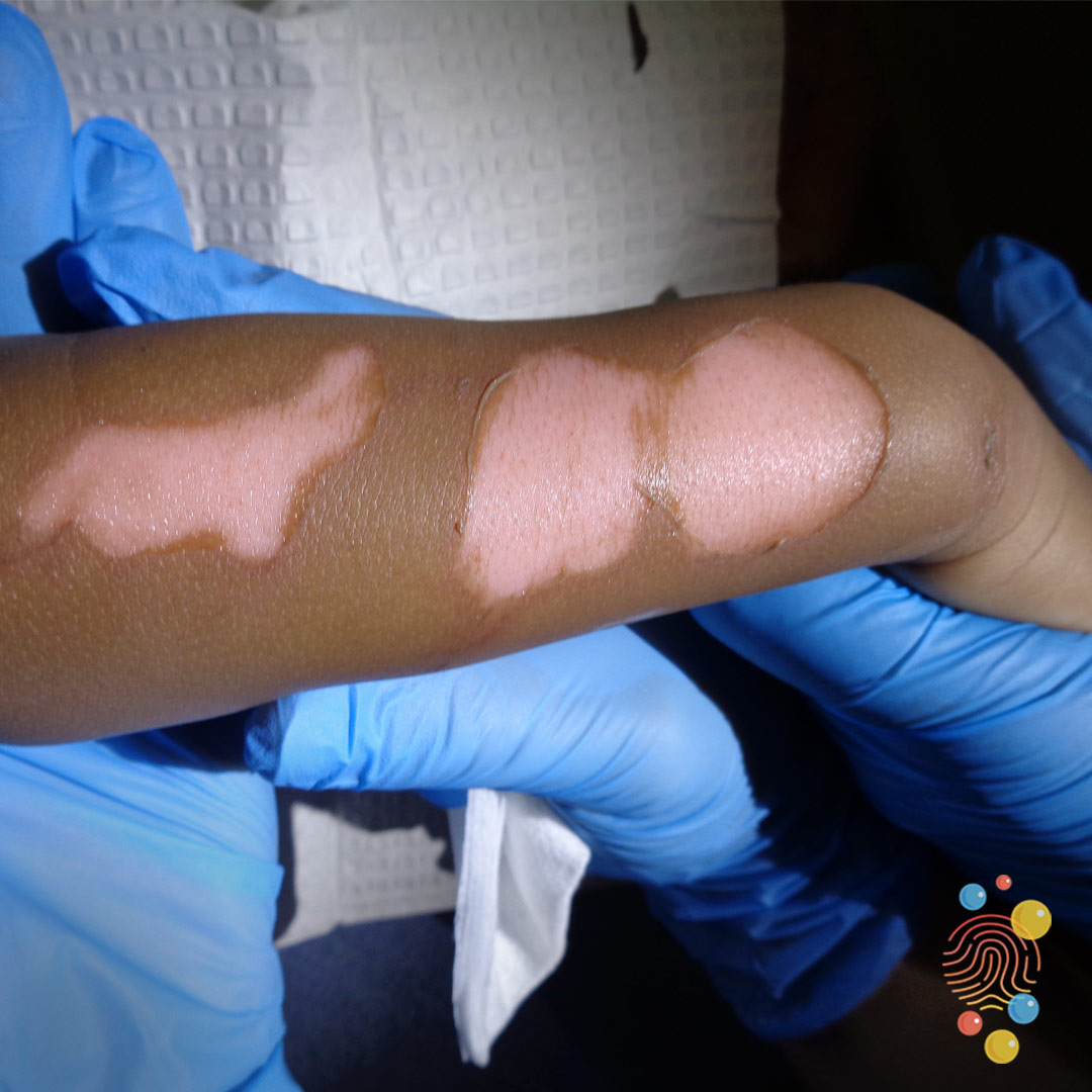 Minor burns are a common Paeds ED presentation. Do you know how to assess them and treat them? Do you deroof your blisters?Do you know how to calculate the total body surface area of the burn?See  http://DFTBSkinDeep.com  for more burns picturesA thread1/12