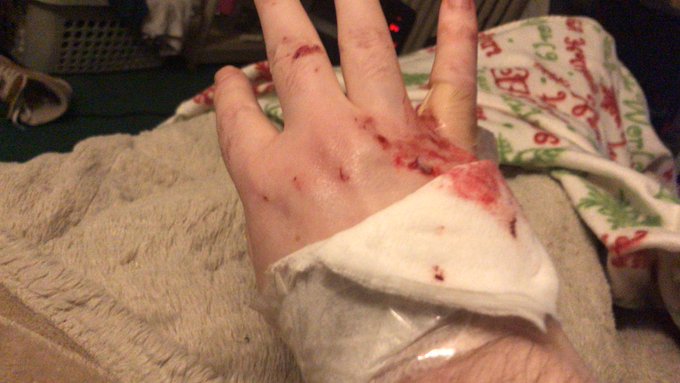 This Is My Bloody 🩸 Hand 🤚 From Me Fckin Up ⬆️ Sum One ☝️ Tonite https://t.co/oVFh8kyHOG
