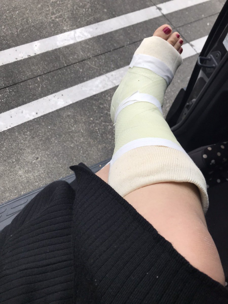 治療中のリアルさん、まだ松葉杖が無いと歩けないそうです。半割ギプスもセクシー❤️ I met a woman who had a broken bone.  Her cast was cut, but she still can't walk without her cane.  Her cast was sexy.