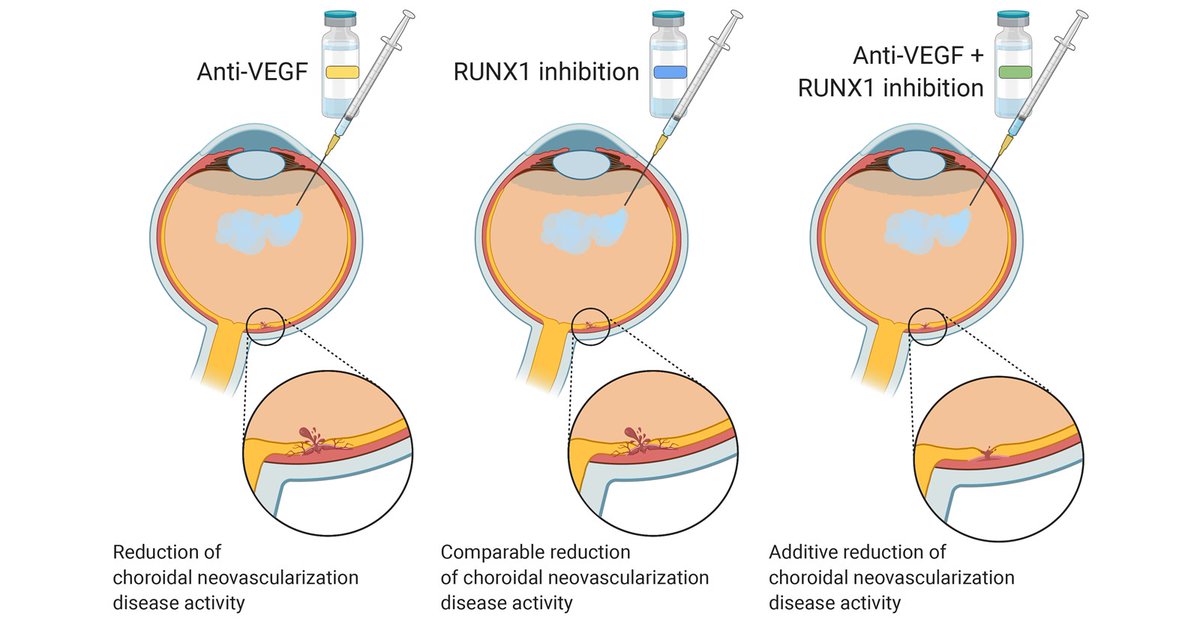 Elsevier News (@elseviernews) on Twitter photo .<a href="/AJPathology/">The American Journal of Pathology</a> profiles a new therapeutic approach that may help treat age-related #maculardegeneration, a leading cause of #vision loss:: bit.ly/3s9KUtk
#eyesight #DetectEarly #TreatEarly .<a href="/AJPathology/">The American Journal of Pathology</a> profiles a new therapeutic approach that may help treat age-related #maculardegeneration, a leading cause of #vision loss:: bit.ly/3s9KUtk
#eyesight #DetectEarly #TreatEarly