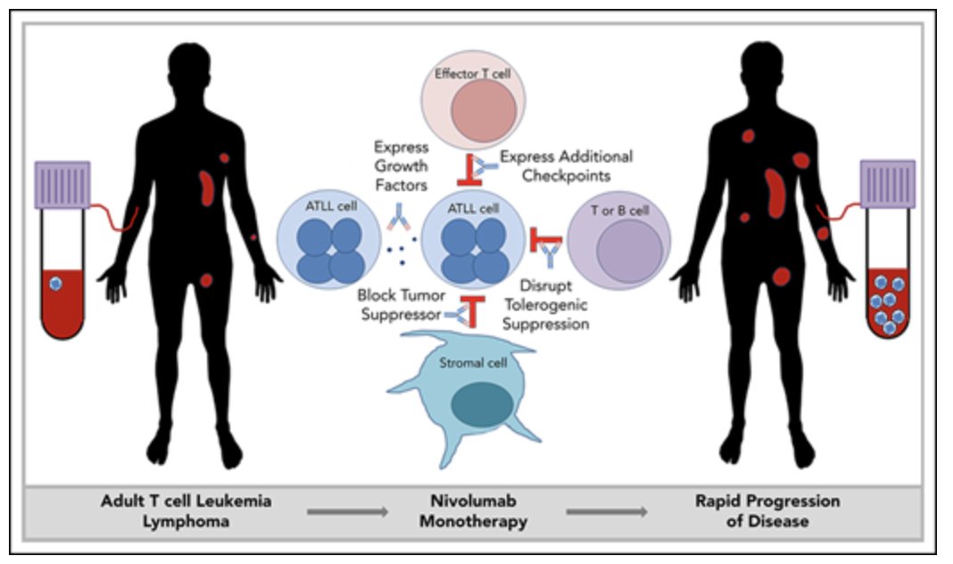 Sydney Olson (@sydney_l_olson) on Twitter photo Talking about Nivolumab as tx for lung cancer in class
<a href="/NUFeinbergMed/">Northwestern Feinberg School of Medicine</a> . Sharing research on unexpected responses in ATL pts txed w/ Nivo:
Rapid progression of adult T-cell leukemia/lymphoma as tumor-infiltrating Tregs after PD-1 blockade pubmed.ncbi.nlm.nih.gov/31467059/
#MedTwitter Talking about Nivolumab as tx for lung cancer in class
<a href="/NUFeinbergMed/">Northwestern Feinberg School of Medicine</a> . Sharing research on unexpected responses in ATL pts txed w/ Nivo:
Rapid progression of adult T-cell leukemia/lymphoma as tumor-infiltrating Tregs after PD-1 blockade pubmed.ncbi.nlm.nih.gov/31467059/
#MedTwitter