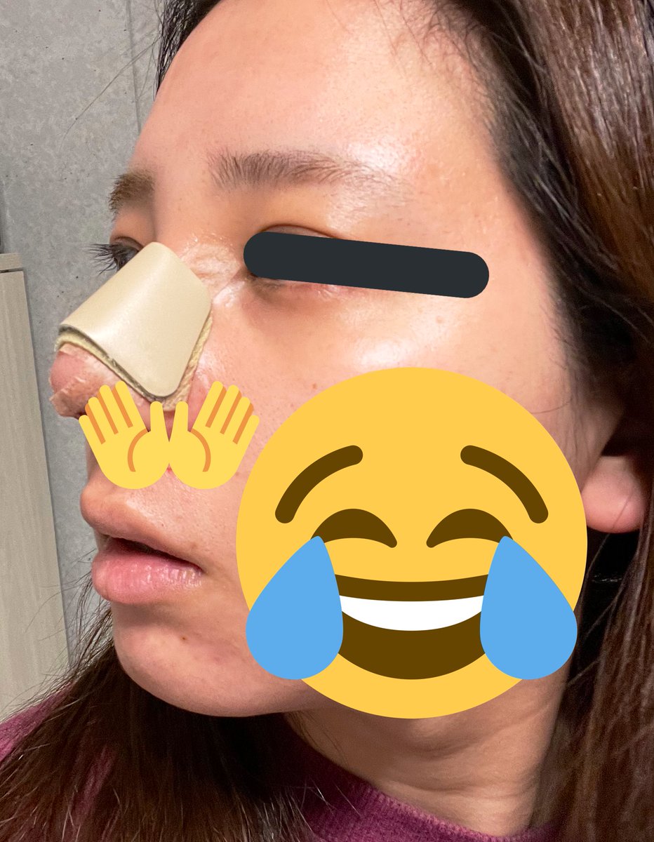リリ2 0 A Twitter Dt1日目 薄い血混じりの鼻水が止まらないものの 数時間で慣れた 特に痛みもなし 寝起きの腫れはすごいが日中はぼちぼち 鼻根は相変わらずはれてる 長時間の睡眠は難しく 喉の乾燥で数時間毎に起きる 枕元に水の常備必須 寝起き 日中