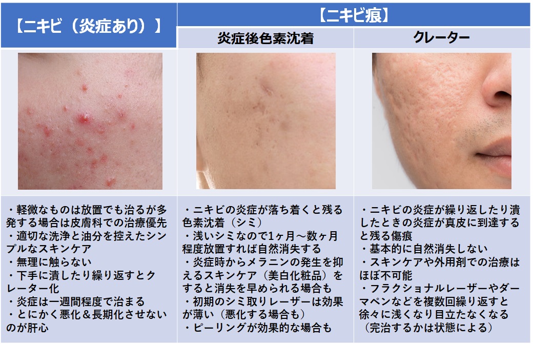 ট ইট র かずのすけ ニキビ痕 にきびあと には主に 炎症後色素沈着 クレーター の２種類があり 炎症後色素沈着は何もせずとも数ヶ月以内に自然消失しますが 美白化粧品の予防的使用でより消失を早めることも可能 クレーターは極めて