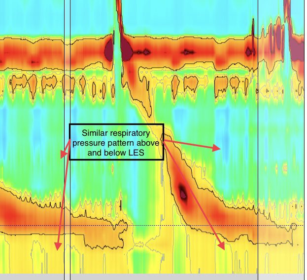 WalterChanMD's tweet photo. From last #TracingTuesday
An important feature of this tracing is the lack of a pressure inversion point (PIP) + the similar pressure patterns by respiration above & below LES. This indicates that the catheter remained above the diaphragm & a large hiatal hernia is present (1/3) https://t.co/T5ygbslVFd