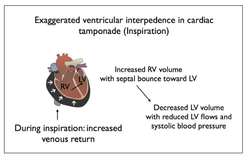 PabloJ's tweet photo. Cardiac tamponade: an educational review @ACVCPresident @rafavidalperez #ESCACVC @ImazioMassimo @krychtiukmd @AgudosSEC
https://t.co/bD0bKEFIpN https://t.co/6vTeUF7Jzd