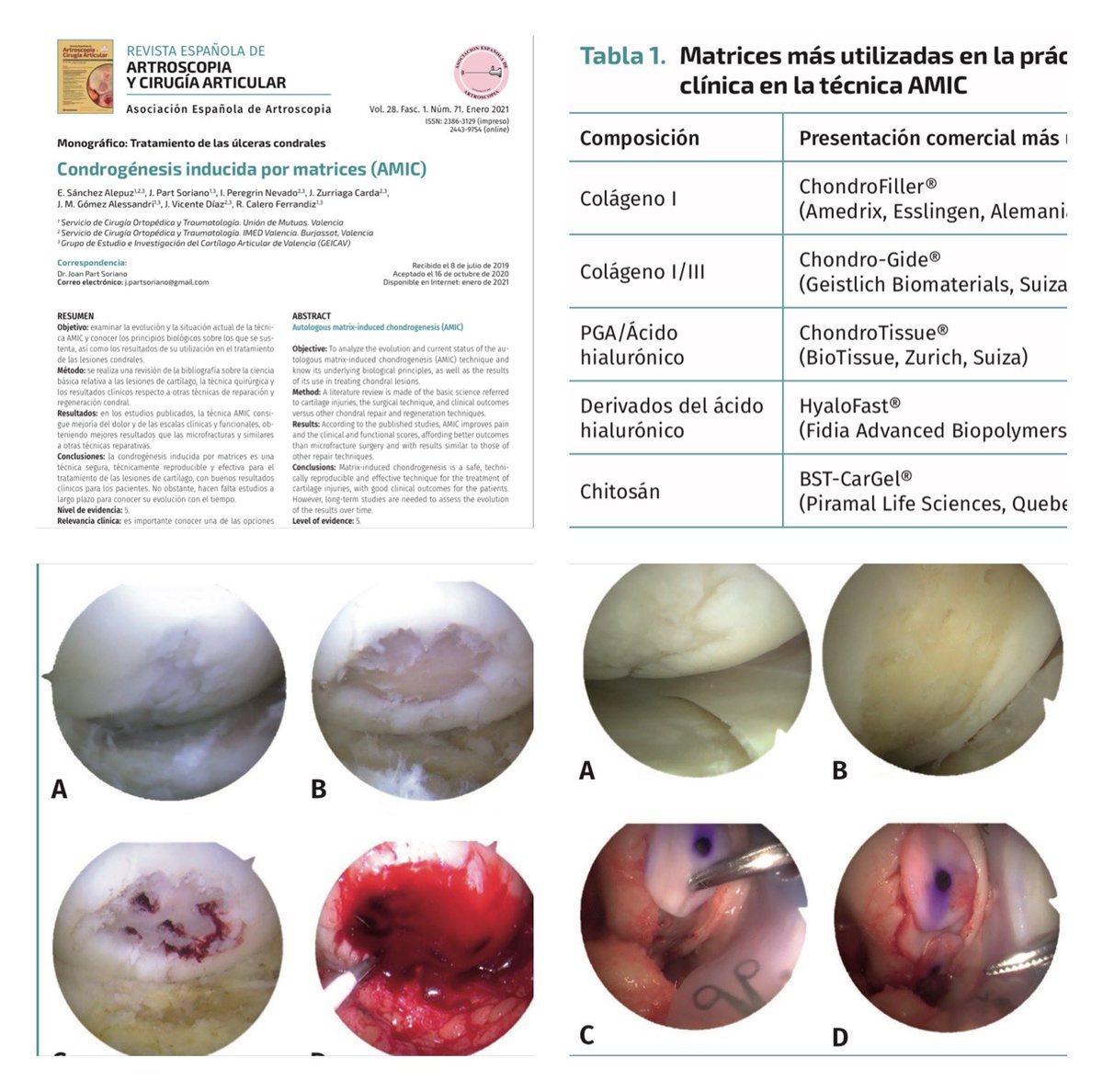 aeartroscopia's tweet photo. 🟣NUEVO ARTÍCULO REACA🟣
✅ Condrogénesis inducida por matrices (AMIC)
▪️Técnica segura, reproducible y efectiva para el tratamiento de las lesiones de cartílago, con buenos resultados clínicos y la ventaja de poder realizarse en una única intervención.
https://t.co/JNue6RL4x6 https://t.co/HLrnCgiIWS