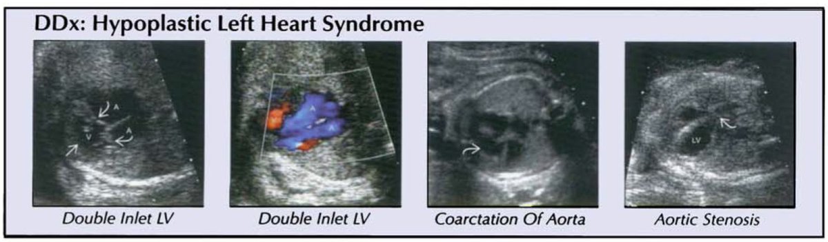 CaraBuskmiller's tweet photo. Section 4 of Woodward's is longer than I expected!

Today I'm learning about AVSD (didn't know it had a classification system or a partial version), HLHS (couldn't form a ddx for this condition before today), coarctation of the aorta, and semilunar valve stenoses. #MFMlearning https://t.co/9pwGSkNYbG