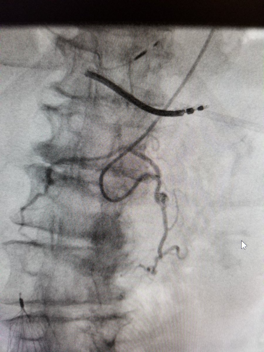 TempleRADs's tweet photo. Patient with bleeding gastric PSA with super squiggly aorta. Failed embo from CFA approach. Transferred to Temple with successful coil embo from radial approach. Awesome work @Nmontec2 @TempleRadRes @SIR_ECS @SIRRFS @SIRspecialists #radialfirst #IRAD https://t.co/Dn9l0hWP18
