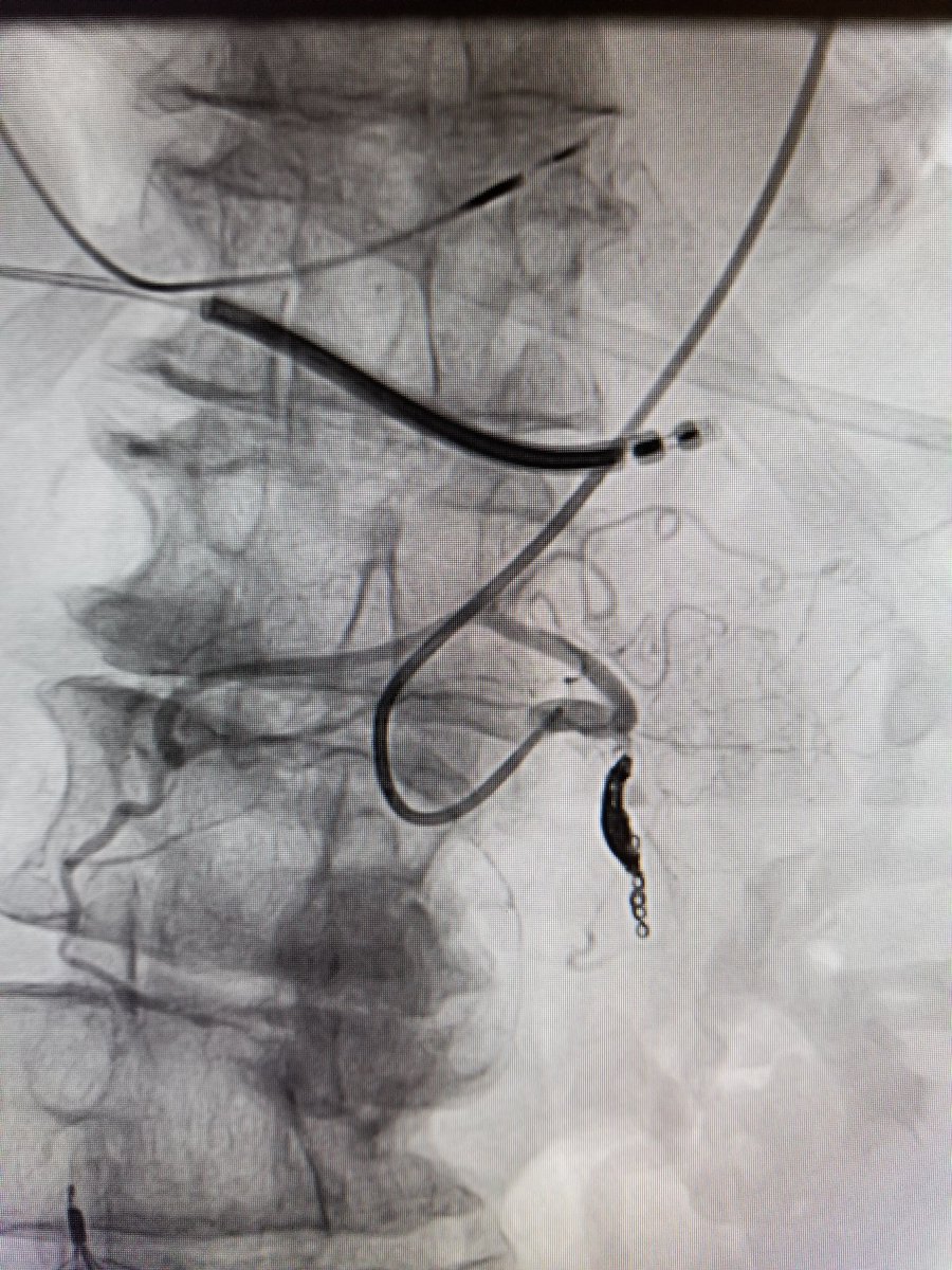 TempleRADs's tweet photo. Patient with bleeding gastric PSA with super squiggly aorta. Failed embo from CFA approach. Transferred to Temple with successful coil embo from radial approach. Awesome work @Nmontec2 @TempleRadRes @SIR_ECS @SIRRFS @SIRspecialists #radialfirst #IRAD https://t.co/Dn9l0hWP18