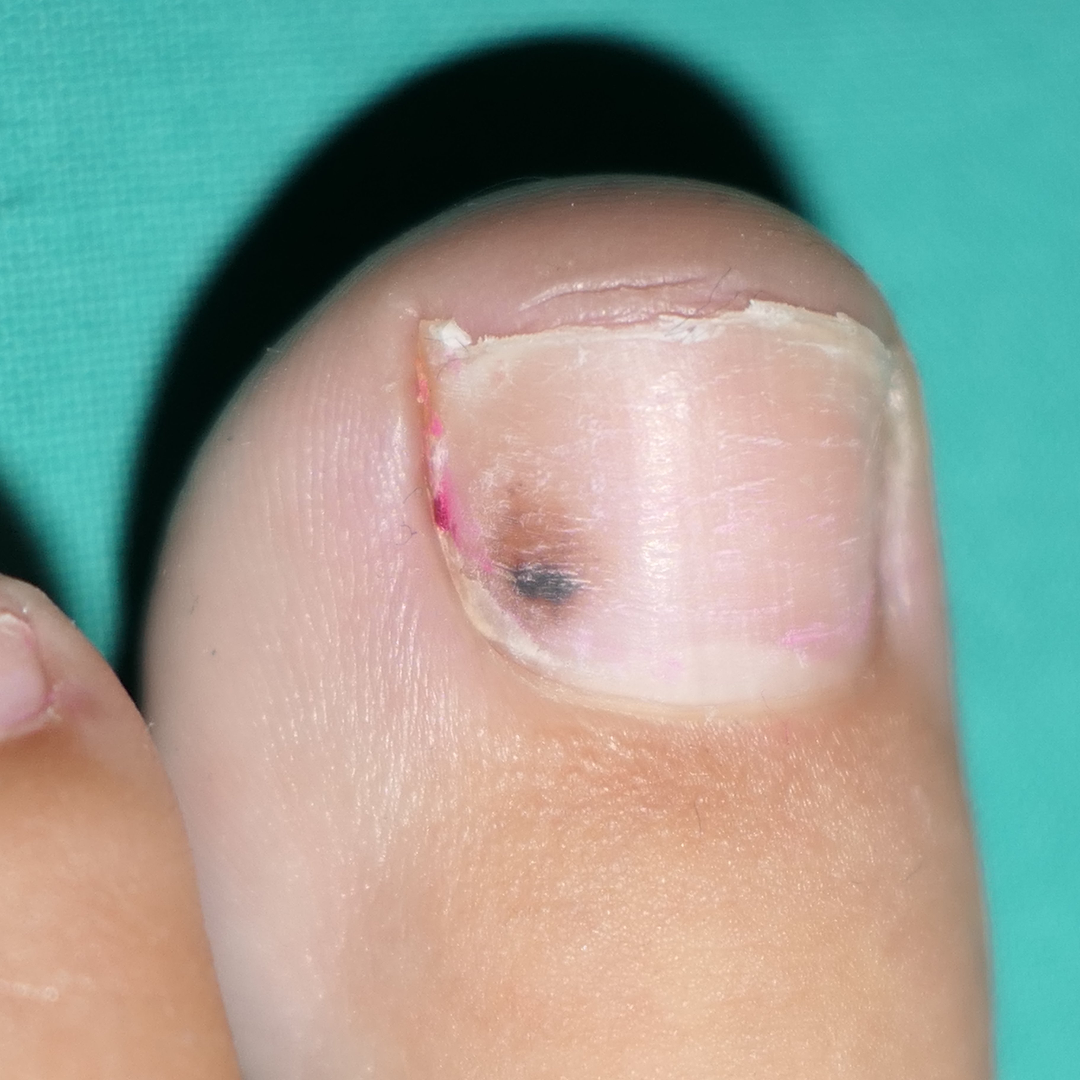 ¿Cuándo se debe acudir al médico por manchas oscuras en las uñas de los pies?