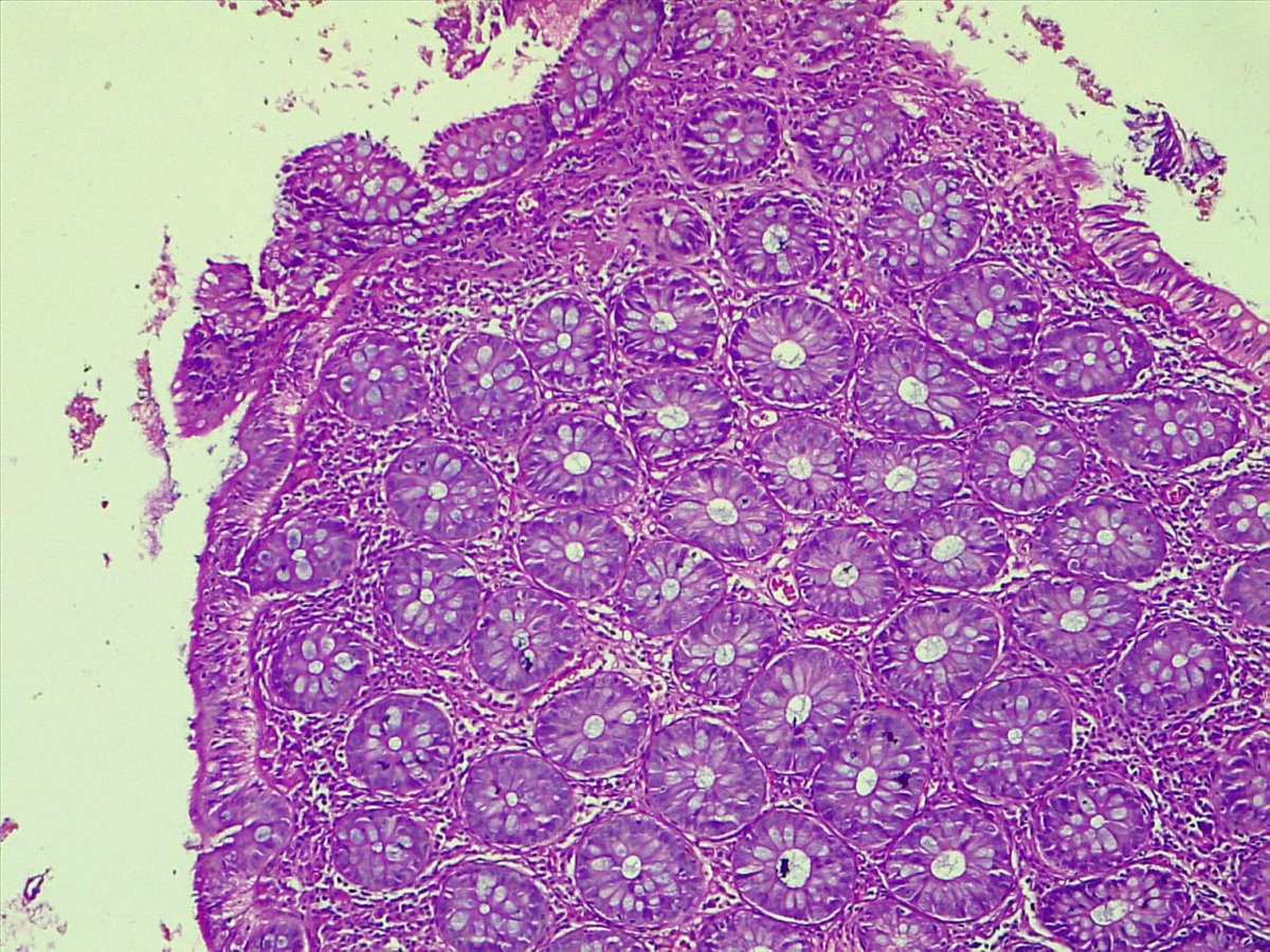 path4ever's tweet photo. 35y male with polyp in ascending colon and sigmoid colon
No.1/2from polyp in ascending colon ur opinion #GITpath #pathologist #Gastroenterology @DraEosina @ariella8 @CArnold_GI https://t.co/bfYI567LgU