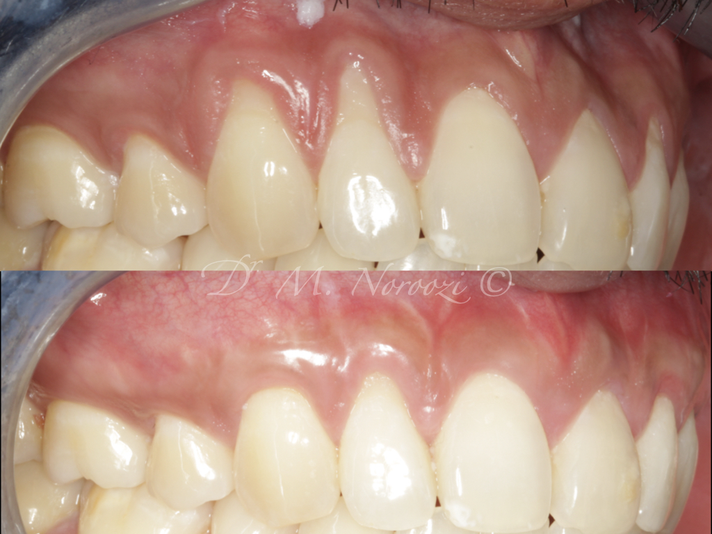 impressperio's tweet photo. #Pinhole Surgical Technique with #allograft #dermal tissue breakthrough #gumgrafting alternative treatment for #gumrecessions, no palatal grafting, no scalpels, quick, easy and instantly pleasing, minimally invasive, patient-friendly and scientifically documented. https://t.co/XuQnmLQjZA