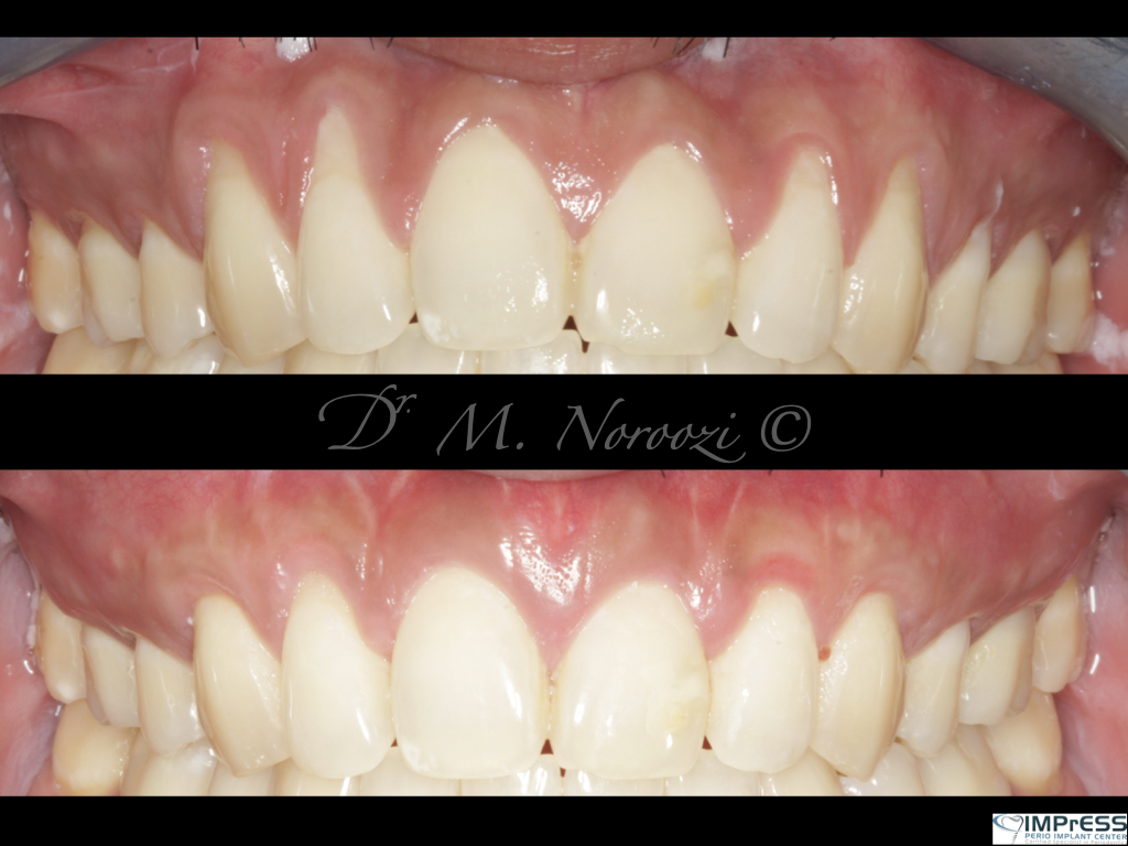 impressperio's tweet photo. #Pinhole Surgical Technique with #allograft #dermal tissue breakthrough #gumgrafting alternative treatment for #gumrecessions, no palatal grafting, no scalpels, quick, easy and instantly pleasing, minimally invasive, patient-friendly and scientifically documented. https://t.co/XuQnmLQjZA