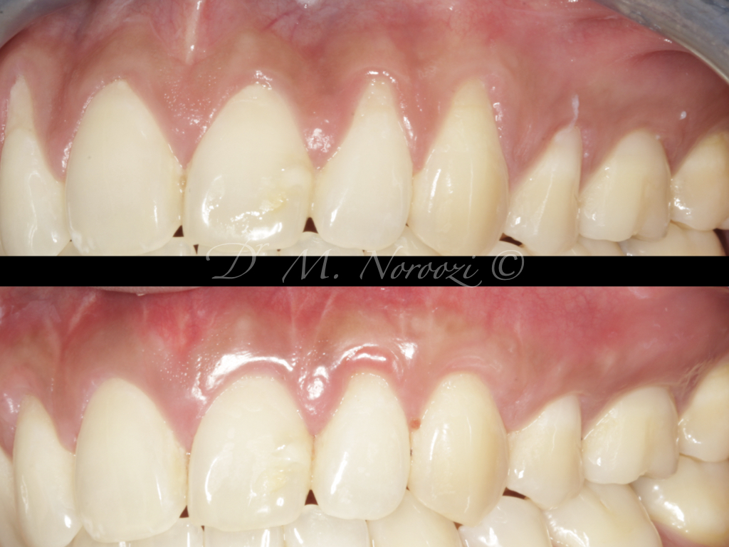 impressperio's tweet photo. #Pinhole Surgical Technique with #allograft #dermal tissue breakthrough #gumgrafting alternative treatment for #gumrecessions, no palatal grafting, no scalpels, quick, easy and instantly pleasing, minimally invasive, patient-friendly and scientifically documented. https://t.co/XuQnmLQjZA