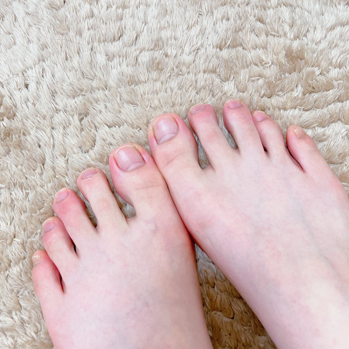 ミヤマ 秋のナチュグレ Twitterissa 足の爪 横筋入りまくってガタガタに波打ってたんだけどフットネイル2週間塗って落としたら少しマシになった気がする 乾燥してたのがネイルで硬化 蓋されて良かったのかしら 落とした2日間はネイルオイルで保湿したので また ミヤマ 秋のナチュグレ Twitterissa 足の爪 横筋入りまくってガタガタに波打ってたんだけどフットネイル2週間塗って落としたら少しマシになった気がする 乾燥してたのがネイルで硬化 蓋されて良かったのかしら 落とした2日間はネイルオイルで保湿したので また