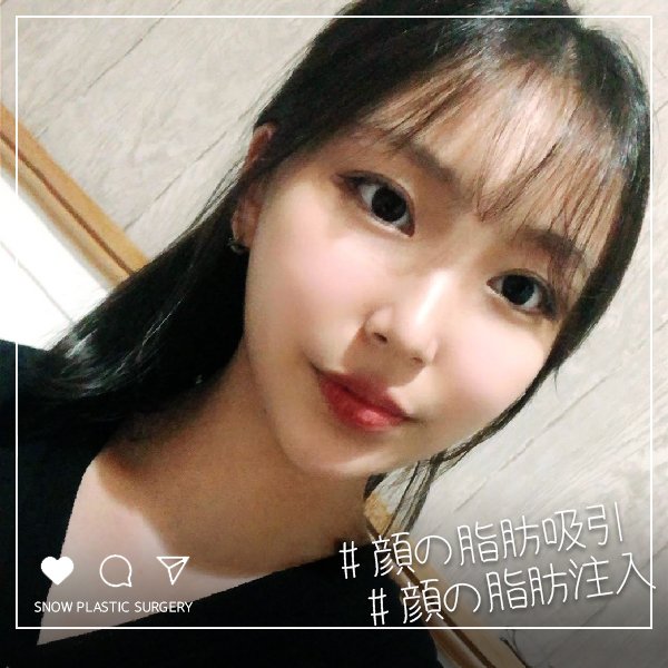 スノウ医院 こんにちは スノウ医院です 顔の脂肪吸引と顔の脂肪注入を同時に行うことで 芸能人のように完璧なフェイスラインに Lineのお問い合わせ Snowprs 日本語対応可能 顔の脂肪吸引 顔の脂肪注入 輪郭術 韓国整形 美容整形 輪郭 江南 スノウ医院 こんにちは スノウ医院です 顔の脂肪吸引と顔の脂肪注入を同時に行うことで 芸能人のように完璧なフェイスラインに Lineのお問い合わせ Snowprs 日本語対応可能 顔の脂肪吸引 顔の脂肪注入 輪郭術 韓国整形 美容整形 輪郭 江南