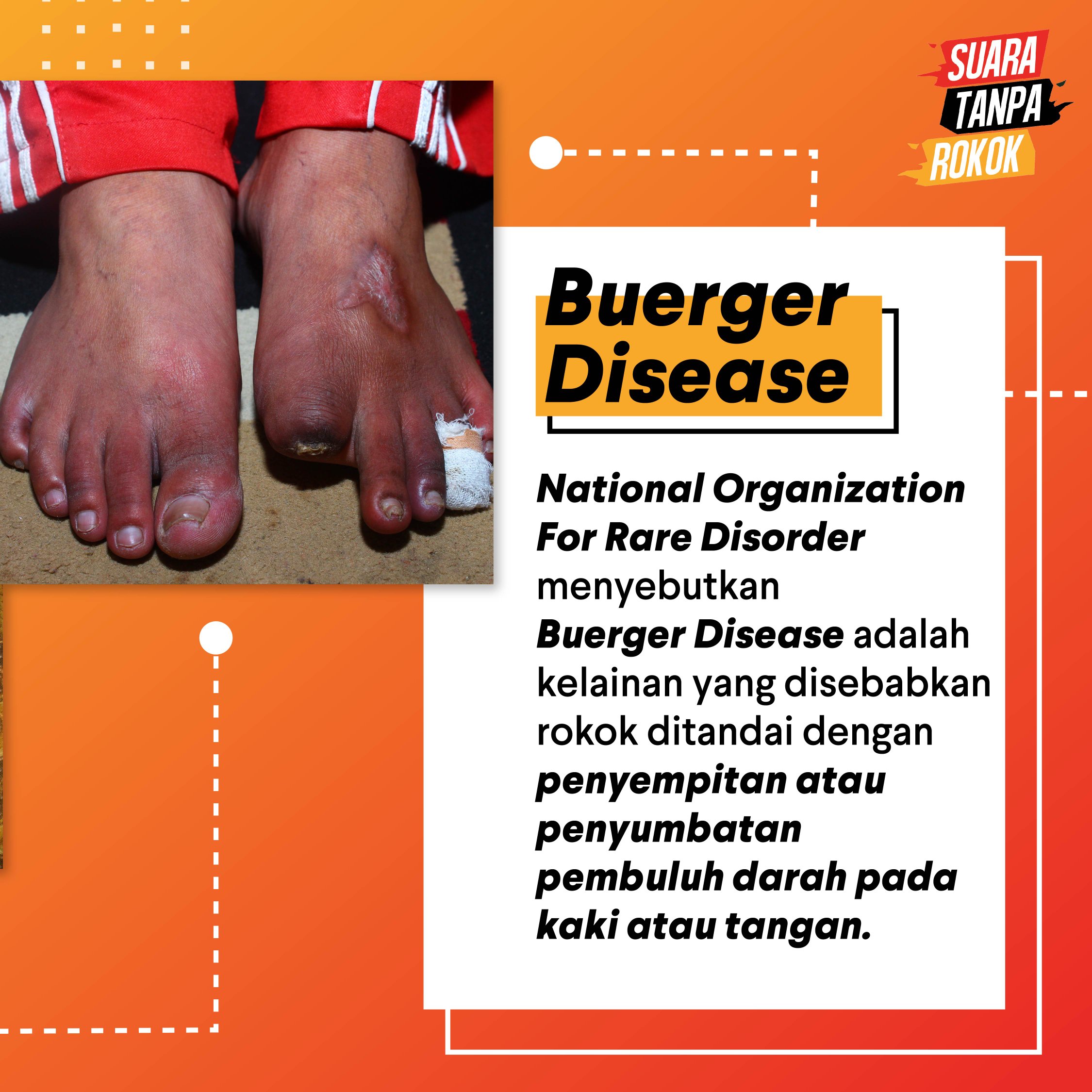 Penyakit Meniere Patofisiologi, Diagnosis, Penatalaksanaan, 48 OFF