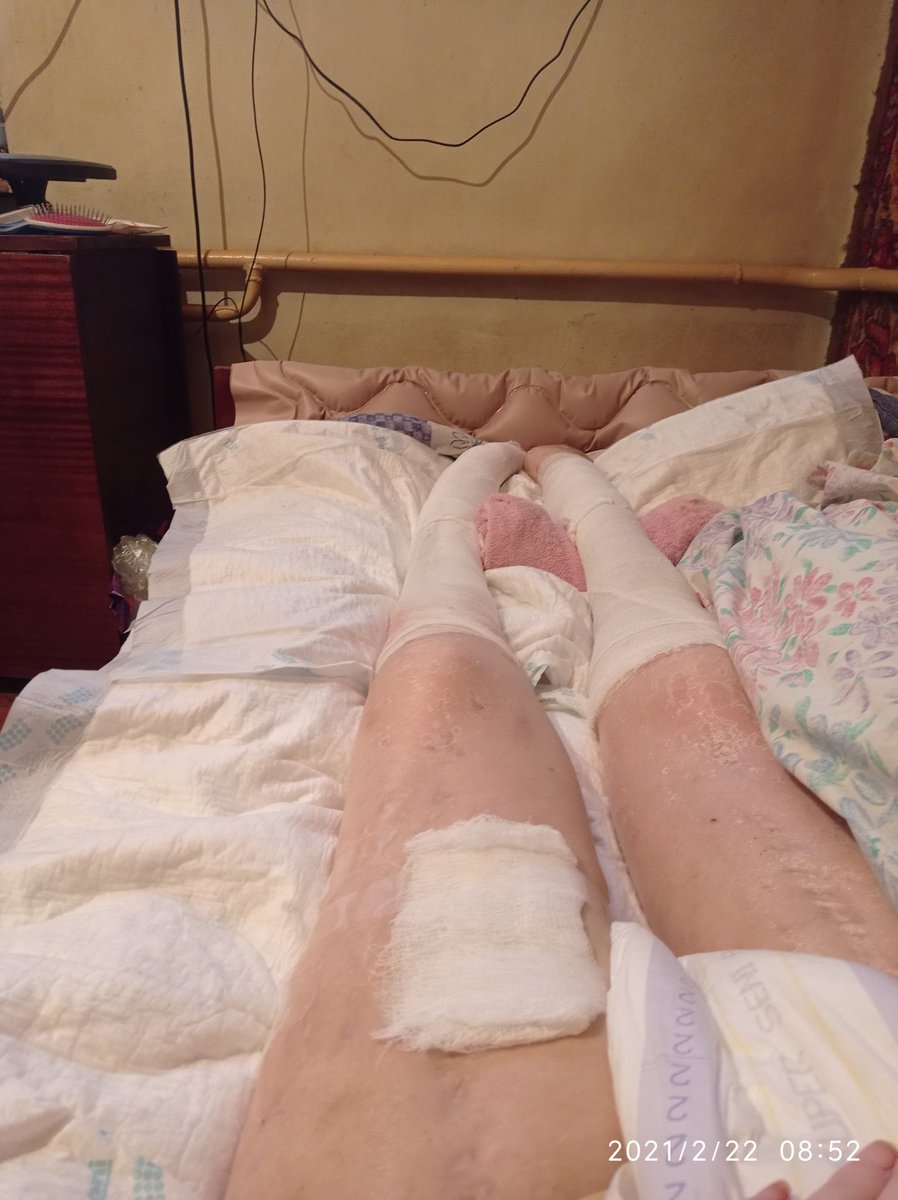 Ребят привет. Друзья я не могу ходить ноги порализована,мама после операции на костылях,больше никого нет у нас. Нужны медикаменты на перевязки, пелёнки еды совсем нет. И перевязочнице нужно. Нужна ваша ПОМОЩЬ. Реттвит уже огромная помощь. У кого возможность есть и 10₽ помощь.