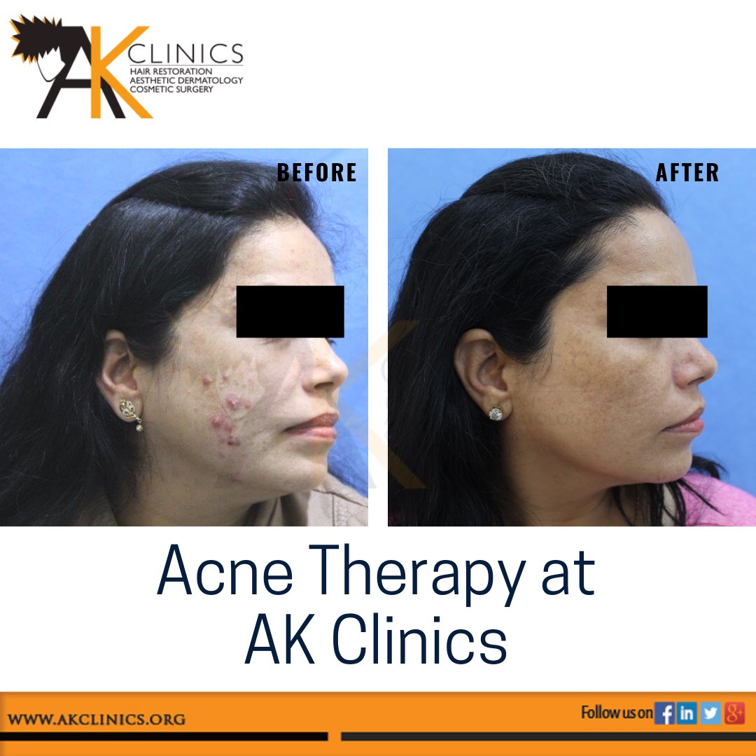 amanakclinics's tweet photo. Mature acne or adult-onset acne is very common these days. Earlier belief that acne burns out by 25 years age is no longer true. We see acne in late 20’s, 30’s even 40s but you need not be worried procedures like black peel and carbon toning can help. https://t.co/rqyzic27sP